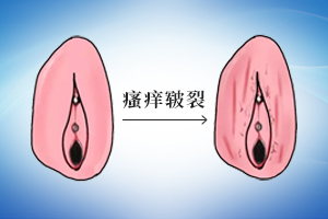 贵阳增生型外阴白斑医院